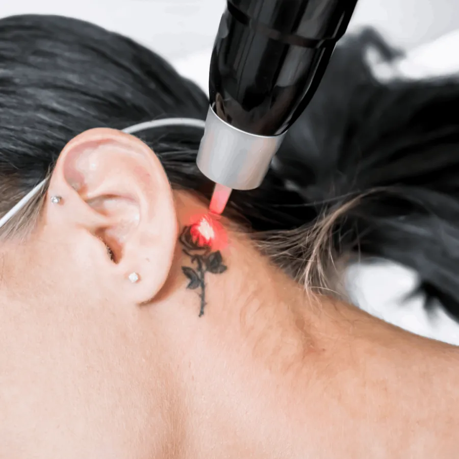 Remoção de tatuagem a laser: como funciona, quantas sessões e cuidados