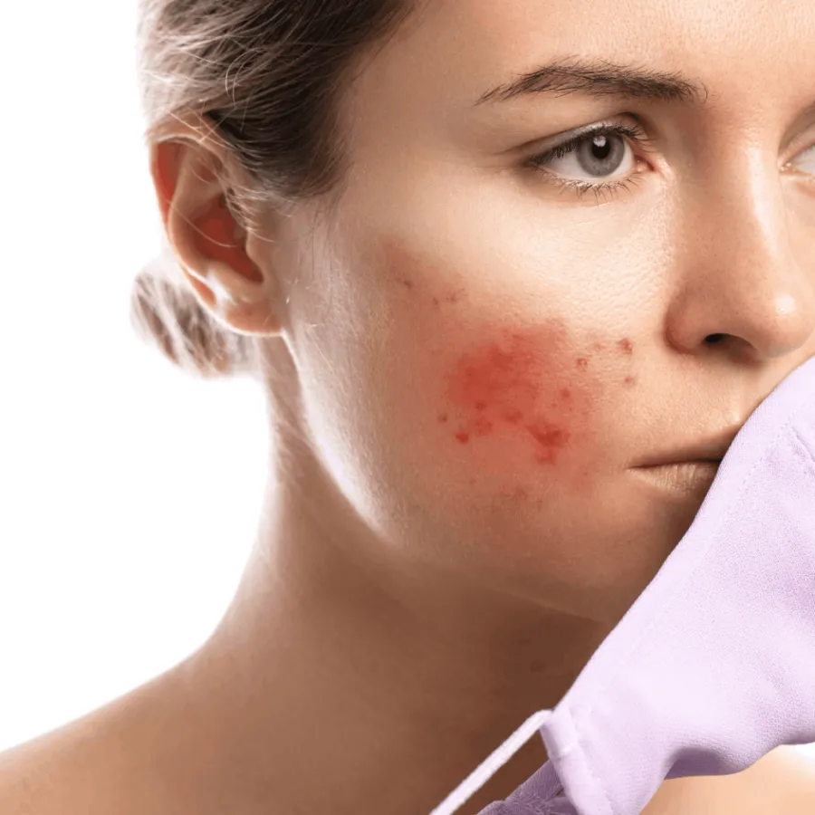 Pelos encravados e foliculite: como a depilação a laser ajuda